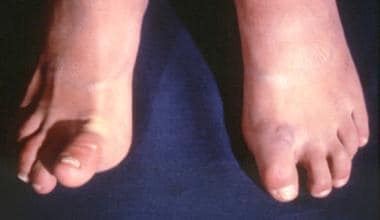 Patient with Ehlers-Danlos syndrome. Note the abno