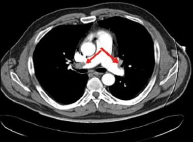 High-altitude pulmonary edema (HAPE). Pulmonary em