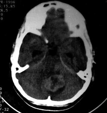 Cerebellar medulloblastoma. This axial view CT sca