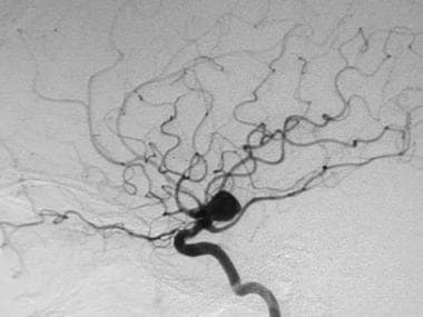 Cerebral angiogram (lateral view) reveals a large 