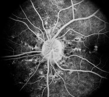 Late fluorescein angiography of the same eye as in