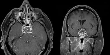 Pituitary Apoplexy Background Pathophysiology Epidemiology - 