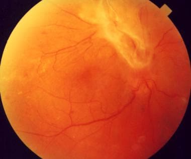 Tractional Retinal Detachment