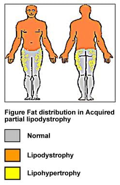 Fat distribution in acquired partial lipodystrophy