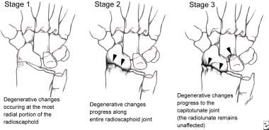 Wrist arthrodesis. Sequence of degenerative change