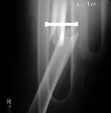 一例股骨骨干骨折的侧位片