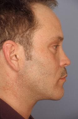 Subperiosteal facelift. After. Lateral view. His l