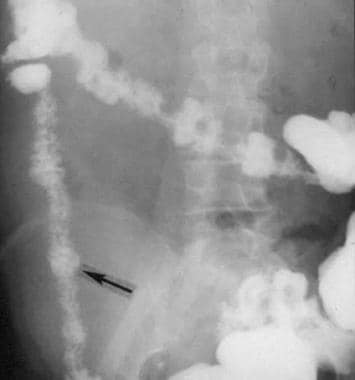 Radiograph showing bowel spasm (early sign of isch