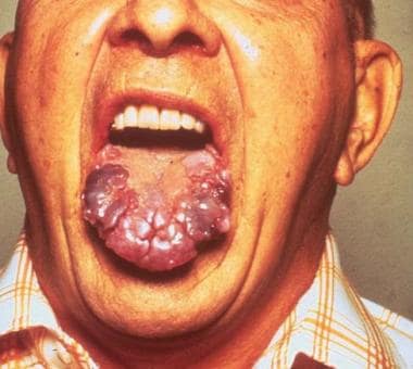Amyloidosis infiltrating the tongue in multiple my