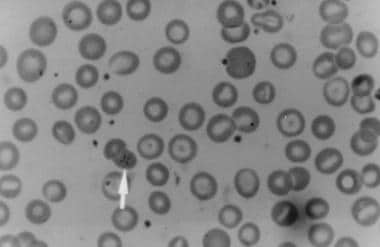 Peripheral smear showing babesiosis. 