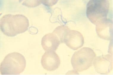Peripheral blood smear in relapsing fever. (Image 