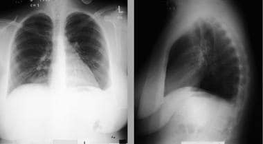 Posteroanterior and lateral chest radiograph findi