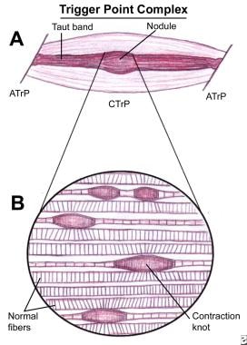 How can I reduce knots in my shoulders (trapezius muscles)? - Myofascial  Pain Solutions