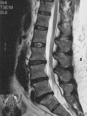 Degenerative changes of the lumbar spine, includin