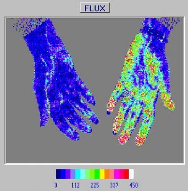 Laser Doppler study of the upper extremities in a 