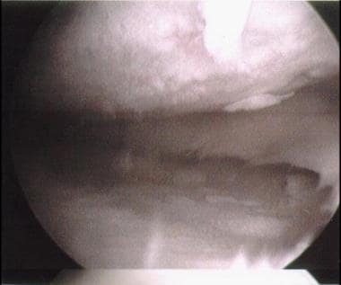 Arthroscopic view of a knee after the removal of l
