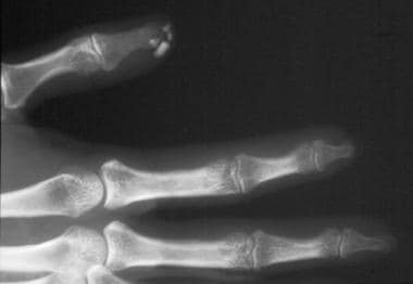 A radiograph of the distal digits demonstrating ca