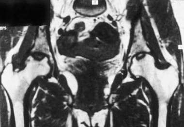 Avascular necrosis of both femoral heads. This T1-