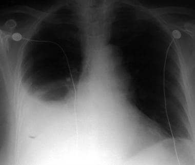Upright posteroanterior chest radiograph of patien