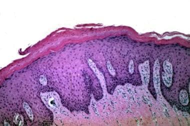 trigone leukoplakia