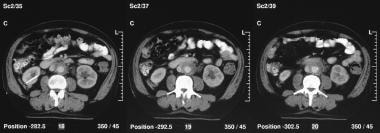Contrast-enhanced CT scan demonstrates a periaorti