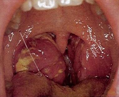 Acute bacterial tonsillitis is shown. The tonsils 