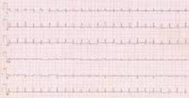 This ECG shows markedly decreased QRS voltage and 