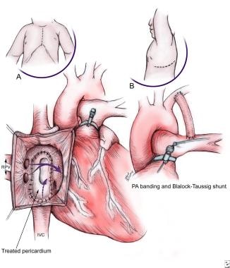 Pulmonary Artery Banding. (A) A partial Senning te