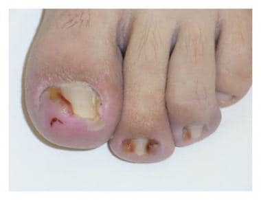 Hypertrophy of the lateral nail fold that partiall