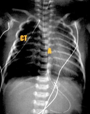 Chest radiograph immediately following repair of e