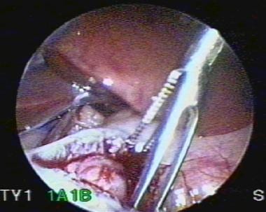 Laparoscopic pyloromyotomy. Spreading of incision.
