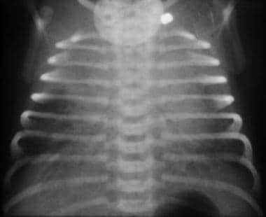 Transient Tachypnea of the Newborn. A supine anter