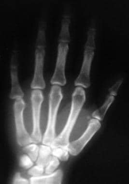 metacarpophalangeal joint dislocation