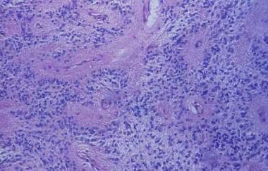 Section displaying typical perivascular pseudorose