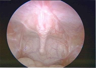Laparoscopic view of urachal fistula, which extend
