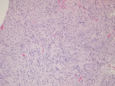 Dense, cellular (Antoni A) area demonstrating area