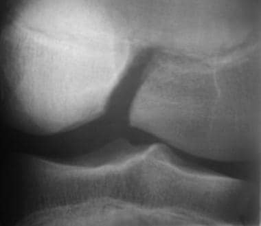 Growth plate (physeal) fractures. Oblique view of 