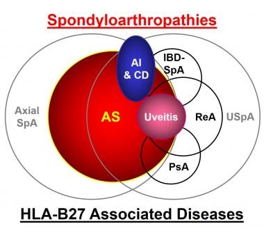 Ankylosing Spondylitis And Undifferentiated Spondyloarthropathy Practice Essentials Background Pathophysiology