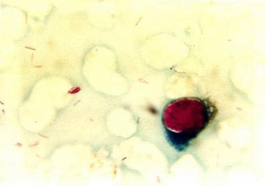 Corneal scraping showing acid-fast bacilli in Hans