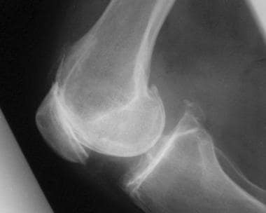 Total knee arthroplasty. Lateral radiograph demons