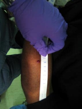 A 3-mm hole in patient forearm (entrance). Courtes