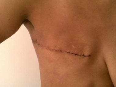 Mastectomy scar 10 days after operation. 