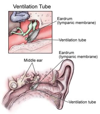 Ear tube in position in eardrum. 