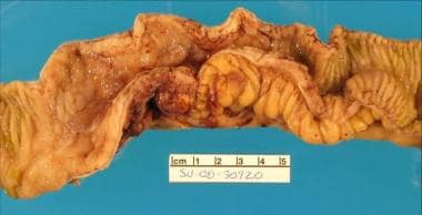 A Crohn stricture of the ileum demonstrating the m