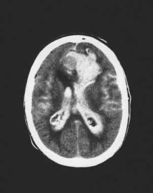 CT scan in 82-year-old woman shows extensive subar