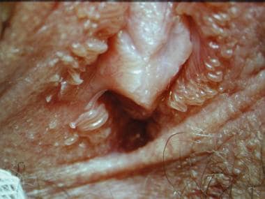 Benign vulvar lesions. Papillomatosis. 