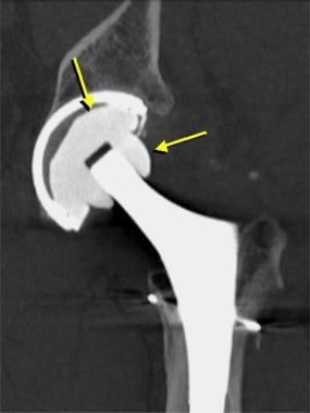 bipolar hemiarthroplasty vs total hip replacement