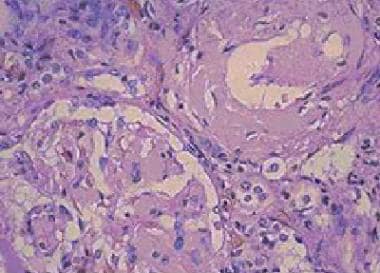 Amorphous eosinophilic interstitial amyloid observ