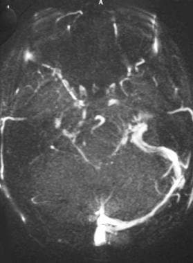 MR venography demonstrates absent flow in the righ