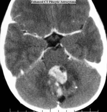 Juvenile pilocytic astrocytoma (JPA). Axial CT sca